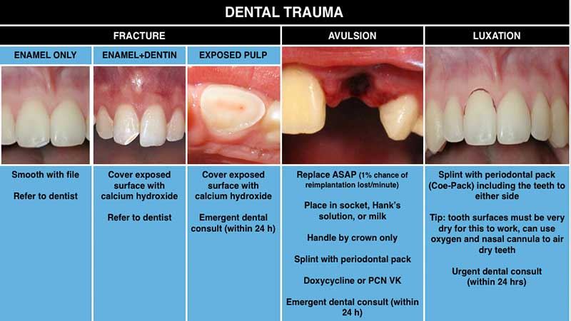کدام دندان‌ها بیشتر دچار ترومای دندان می‌شوند؟
