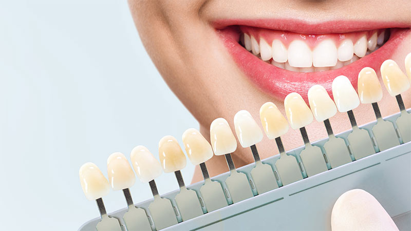 تفاوت آفیس بلیچینگ با هوم بلیچینگ - مزایای بلیچینگ دندان