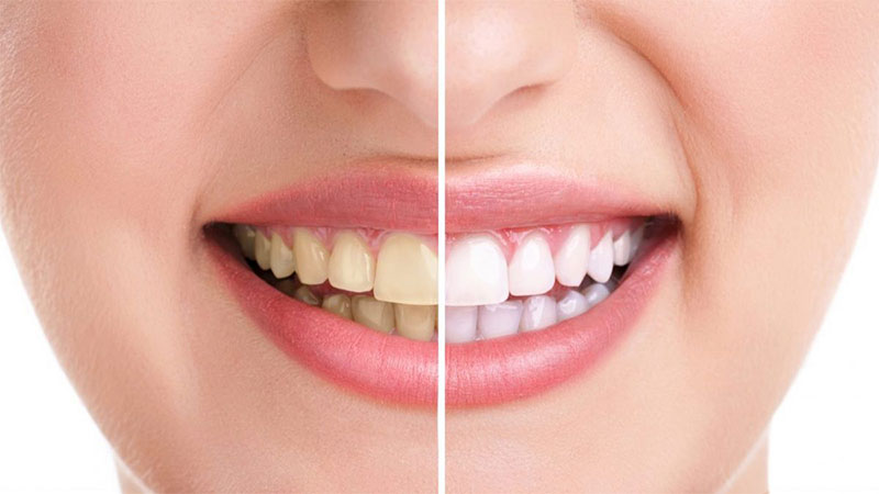 چگونه دندان‌های خود را پس از بلیچینگ دندان سفید نگه داریم؟ - مزایای بلیچینگ دندان