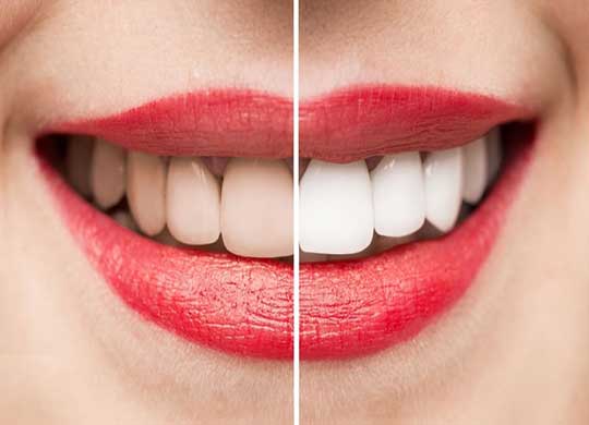 سفید کردن دندان از طریق بلیچینگ