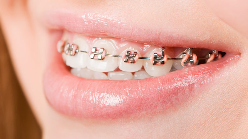 چگونه یک مال الکوژن دندان ها درمان می‌شود؟