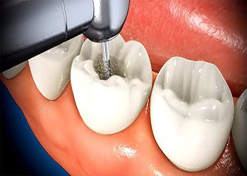 عمر دندان عصب کشی شده چقدر است؟
