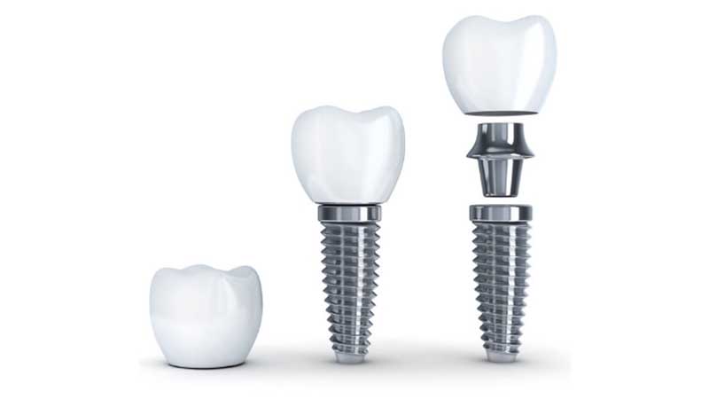 آیا ایمپلنت دندان با مصرف داروی مسکن خوراکی درد دارد؟