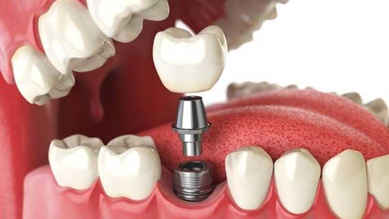 عوارض بعد از درمان ایمپلنت دندان
