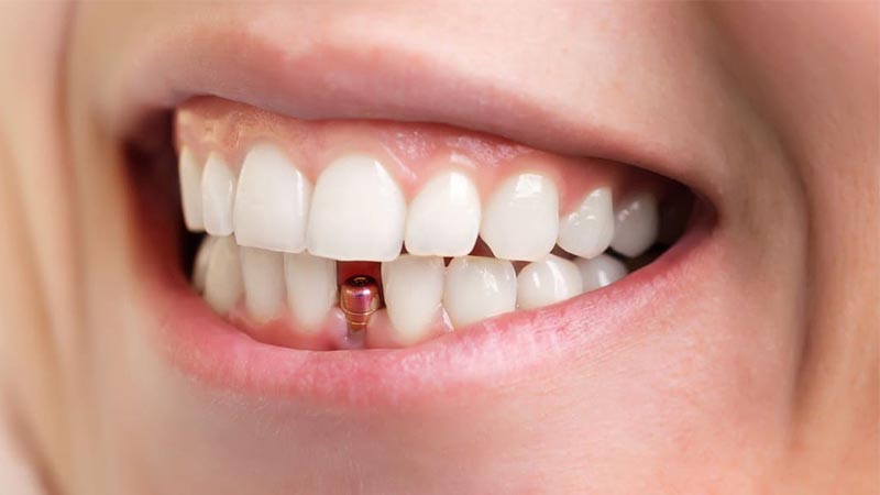 تبلیغات یک روزه ایمپلنت فوری یا ایمپلنت دندان به چه صورت هستند؟