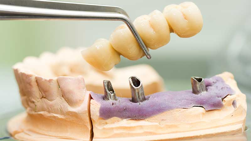 جراحی‌های Prosthodentic‏ (کاشت قطعات مصنوعی دندان)