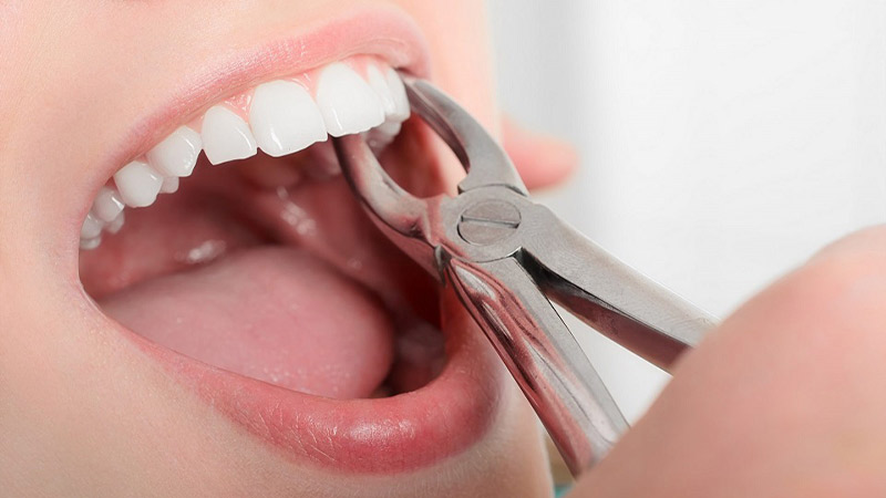 در چه مواردی در کشیدن دندان از جراحی استفاده می‌شود؟