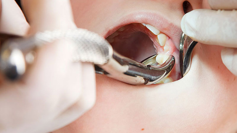 در کشیدن دندان دندانپزشک از چه ابزارهایی استفاده می‌کند؟