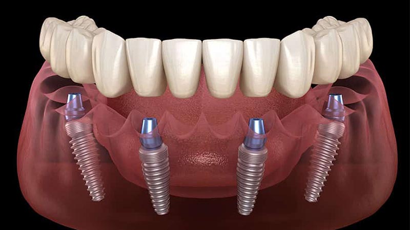 طول مدت جراحی ایمپلنت دندان