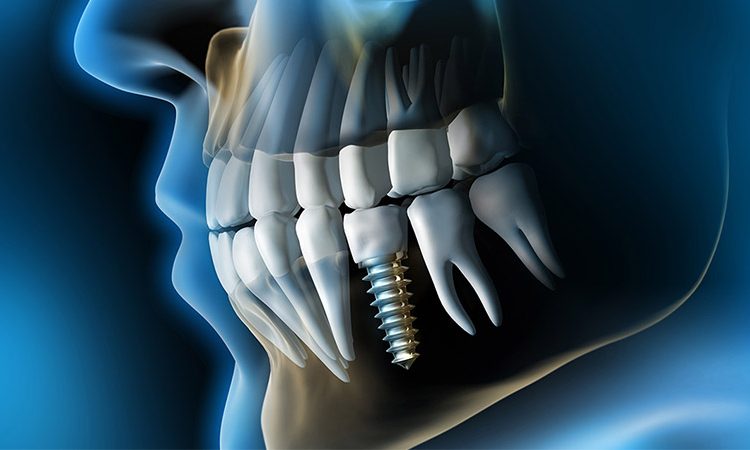ایمپلنت دندان چقدر طول میکشد