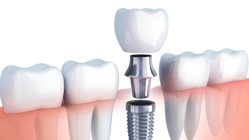 ایمپلنت دندان چند مرحله دارد؟