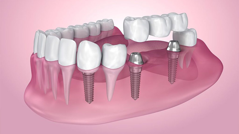 مراحل ایمپلنت دندان چقدر طول می‌کشد؟