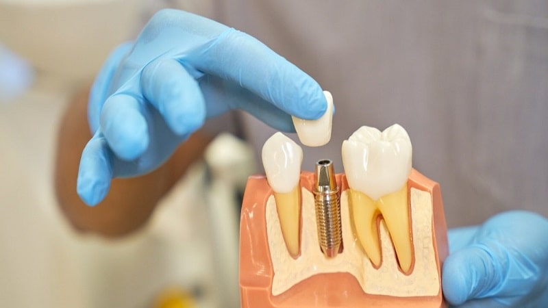 معرفی ایمپلنت دندان