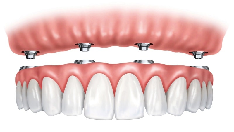 تفاوت انواع ایمپلنت دندان