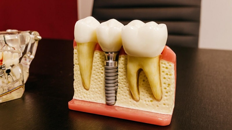 انواع ایمپلنت دندان معمولی