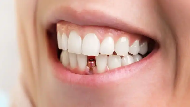 روکش تک واحدی دندان