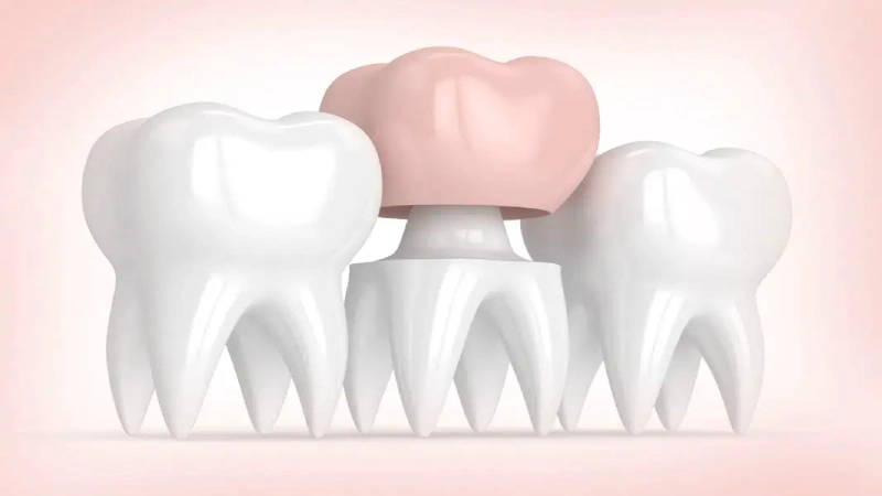 آیا ترمیم دندان بدون تاج با بیلداپ دندان امکانپذیر است؟