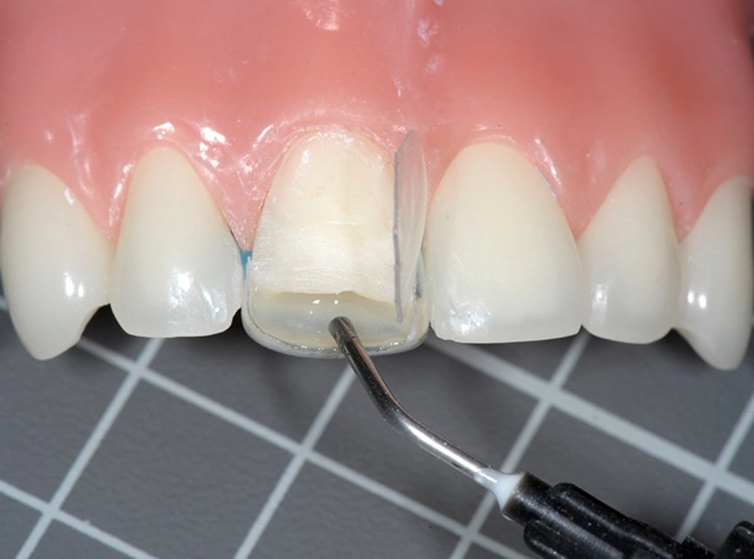 ترمیم کردن دندان با کامپوزیت یا روش باندینگ رزین