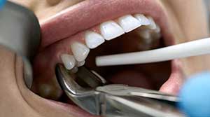 دندانپزشک برای کشیدن دندان از چه ابزارهایی استفاده می‌کند؟