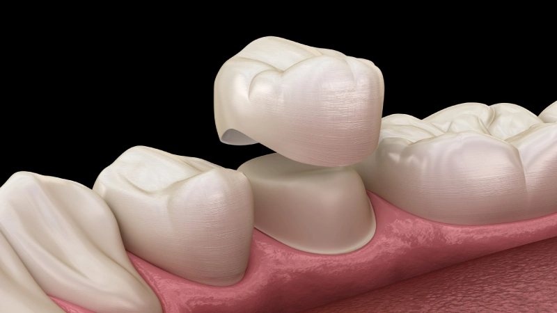 نکات مهم در بازسازی تاج دندان
