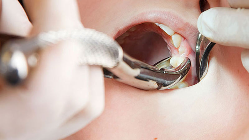 کشیدن دندان در چه مواقعی به کار می‌رود؟