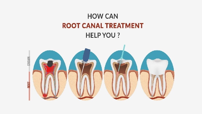 علت تفاوت قیمت در هزینه عصب کشی دندان چیست؟