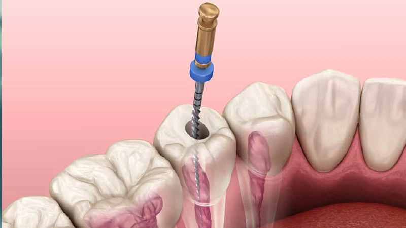 مراحل عصب کشی دندان