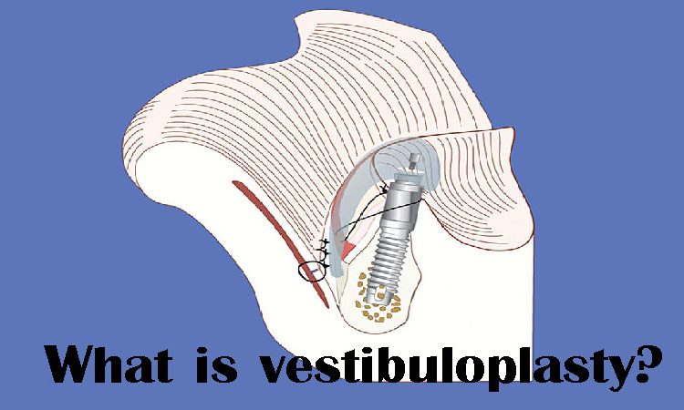 وستیبولوپلاستی چیست؛ مزیت‌های جراحی آن