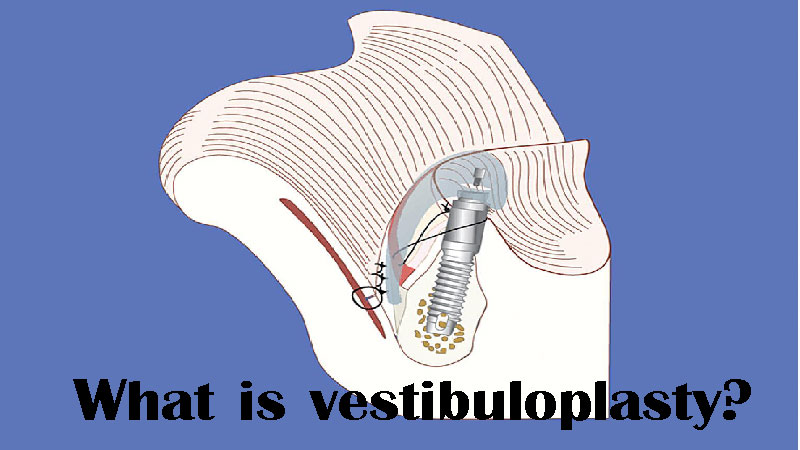 وستیبولوپلاستی چیست؛ مزیت‌های جراحی آن