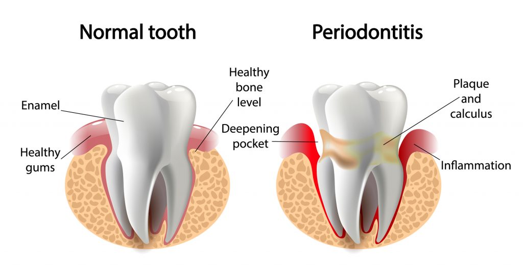 کلینیک دندانپزشکی آرکا - درمانهای غیرجراحی لثه 