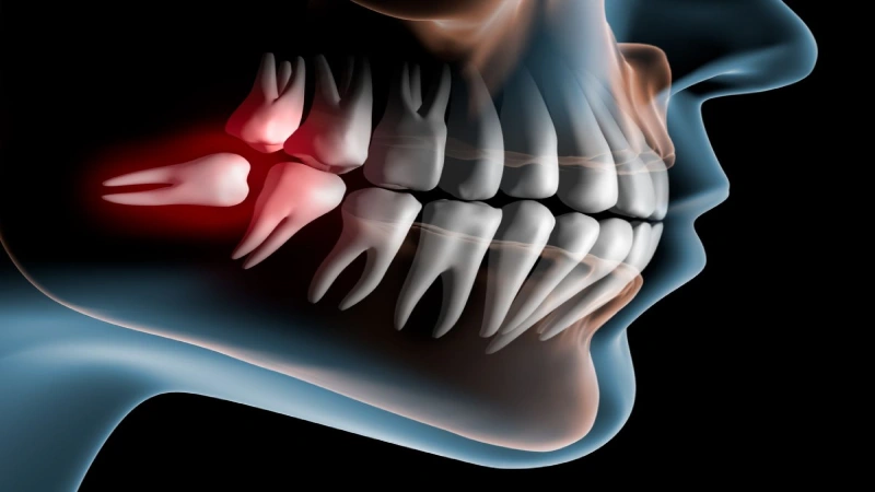 آیا دندان عقل باید کشیده شود؟ به چه علت؟