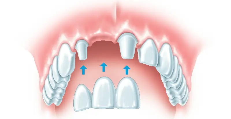 جایگزین کردن دندان از دست رفته به چه صورت انجام می شود؟