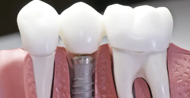 دلایل استفاده از روش های جایگزین ایمپلنت دندان