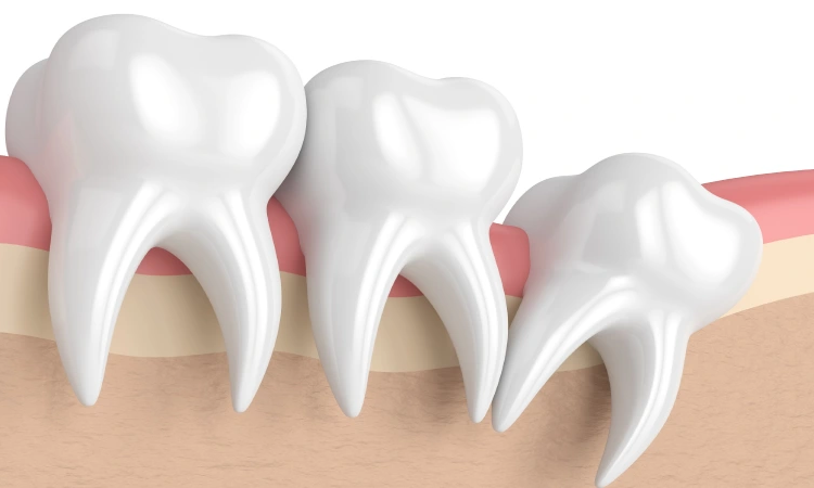 دندان عقل چیست؛ دلیل نهفتگی آن