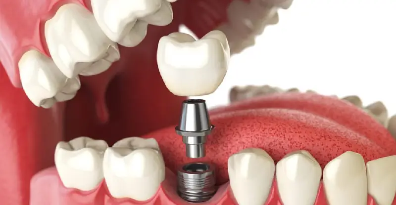 روش های درمانی برای جایگزین کردن دندان از دست رفته