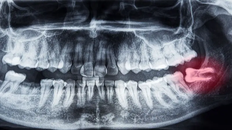 شکل رشد دندان عقل