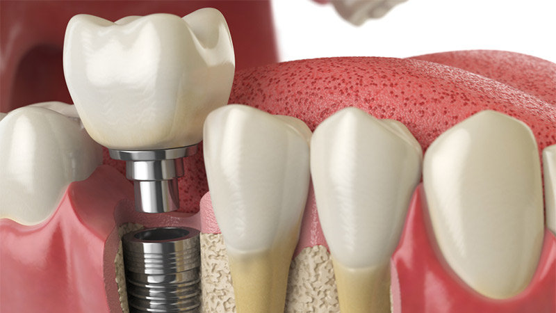 هزینه ایمپلنت دندان با پروتز دندان کامل و متحرک