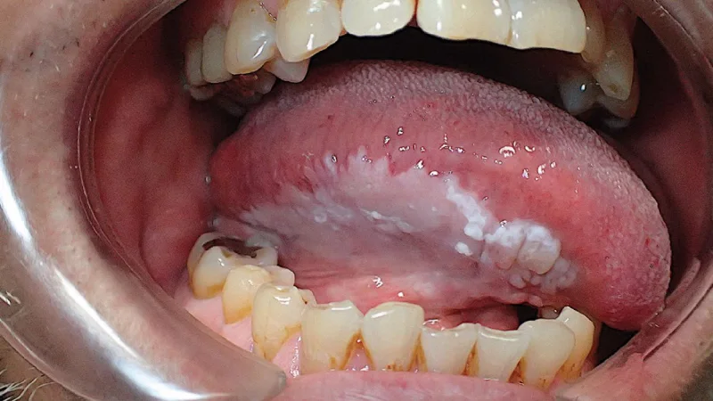 پیشگیری از لکوپلاکیا دهانی
