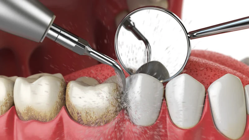 روش های جرم گیری دندان