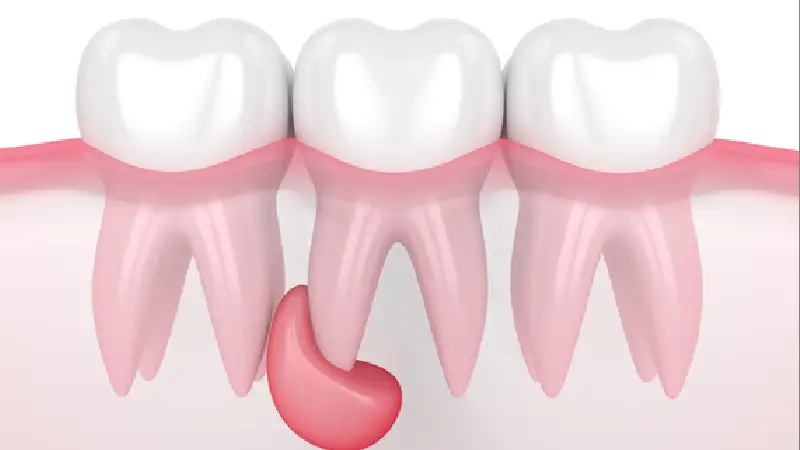 کیست دندان چیست