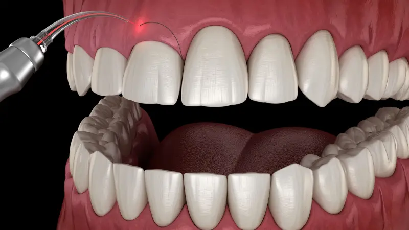 جراحی افزایش طول تاج دندان به چه صورت انجام می‌شود؟