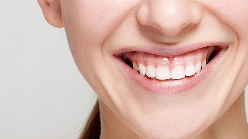 لبخند لثه ای چیست؛ درمان آن به روش جراحی و غیر جراحی