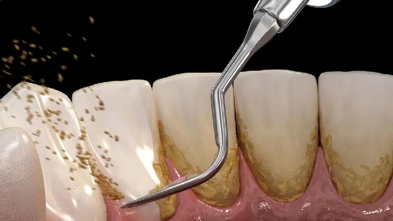روش درمان کیست دندان