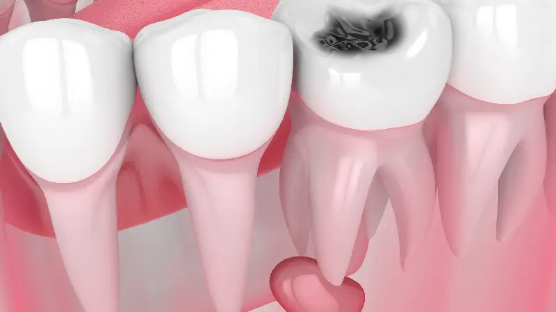 درمان کیست دندان چیست