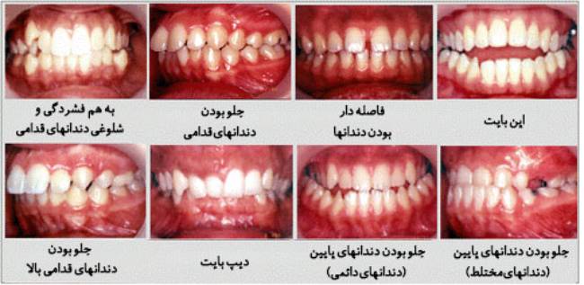انواع ناهنجاری دندان