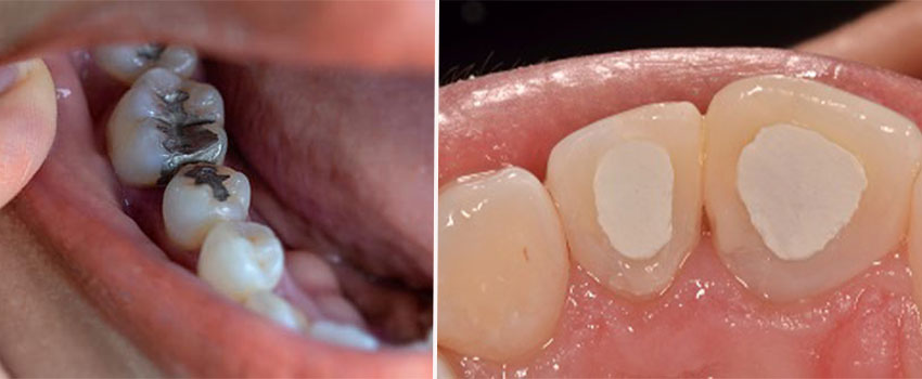 تفاوت عصب کشی دندان جلو و دندان عقب