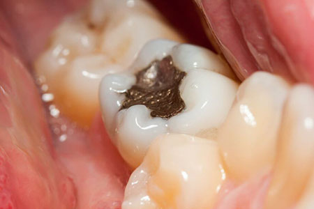 بعد از عصب کشی دندان چه اتفاقی می‌افتد؟