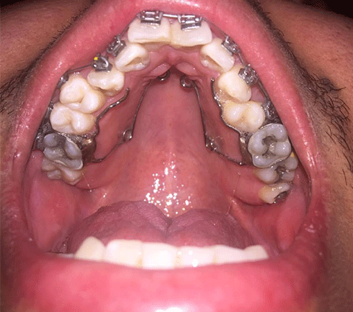 سیم کشی دندان