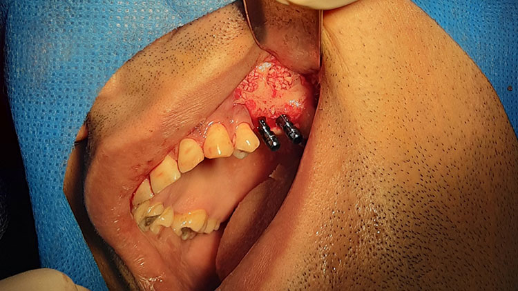 پیوند-استخوان-و-سینوس-لیفت-برای-ایمپلنت-دندان
