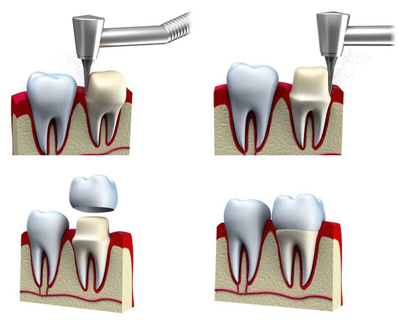 مراحل انجام روکش دندان